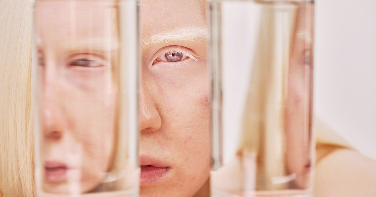 Ung thư da có mối liên quan với bệnh bạch tạng