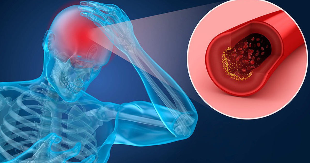 Các dấu hiệu sớm cảnh báo đột quỵ