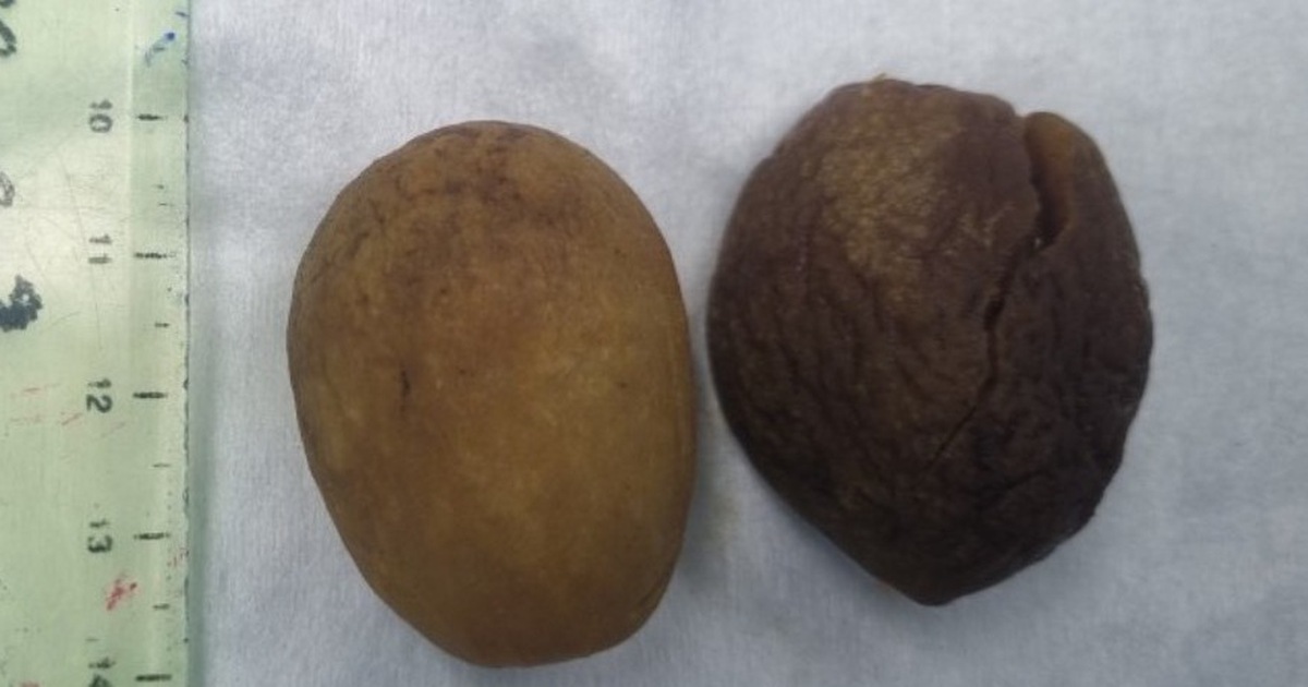 Cụ ông 85 tuổi tắc ruột do nuốt trái chà là