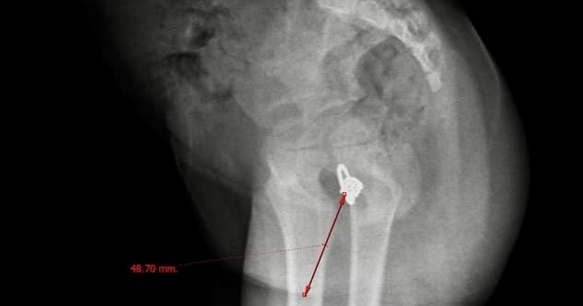 Lưu ý khi phát hiện dị vật tại vùng kín của trẻ