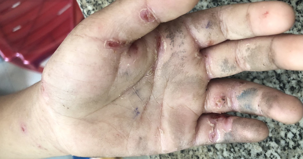 Quảng Ngãi: Phát hiện thêm 1 xã miền núi có hàng trăm người mắc bệnh ghẻ