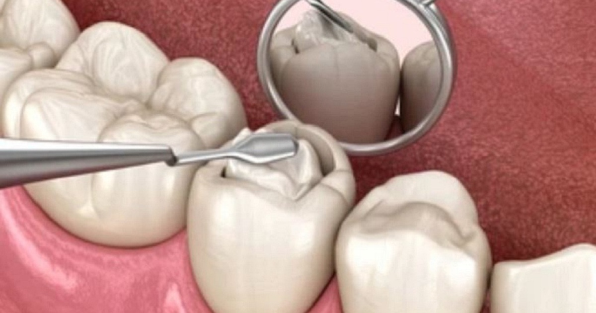 Trám răng xong, chờ bao lâu mới được ăn uống bình thường?