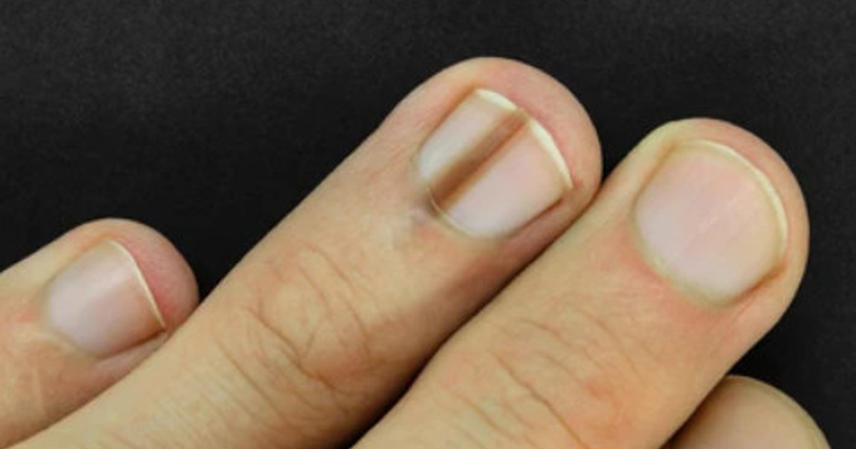 Dấu hiệu ở m&oacute;ng tay, ch&acirc;n cảnh b&aacute;o ung thư