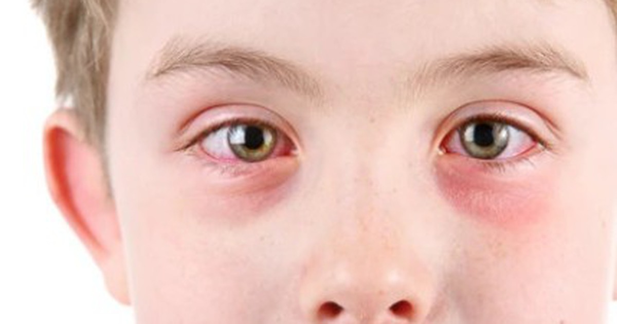 Đau mắt đỏ, khi nào cần đi bác sĩ khám?