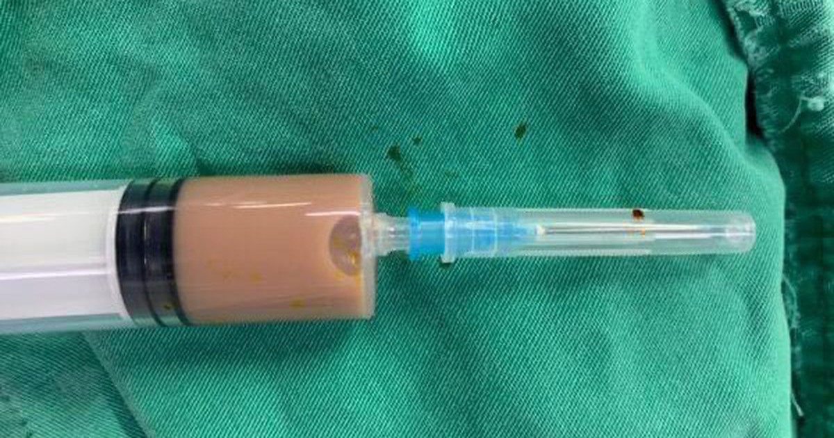 Cấp cứu do ổ áp xe lưng chứa đầy dịch mủ sau tiêm thuốc của thầy lang