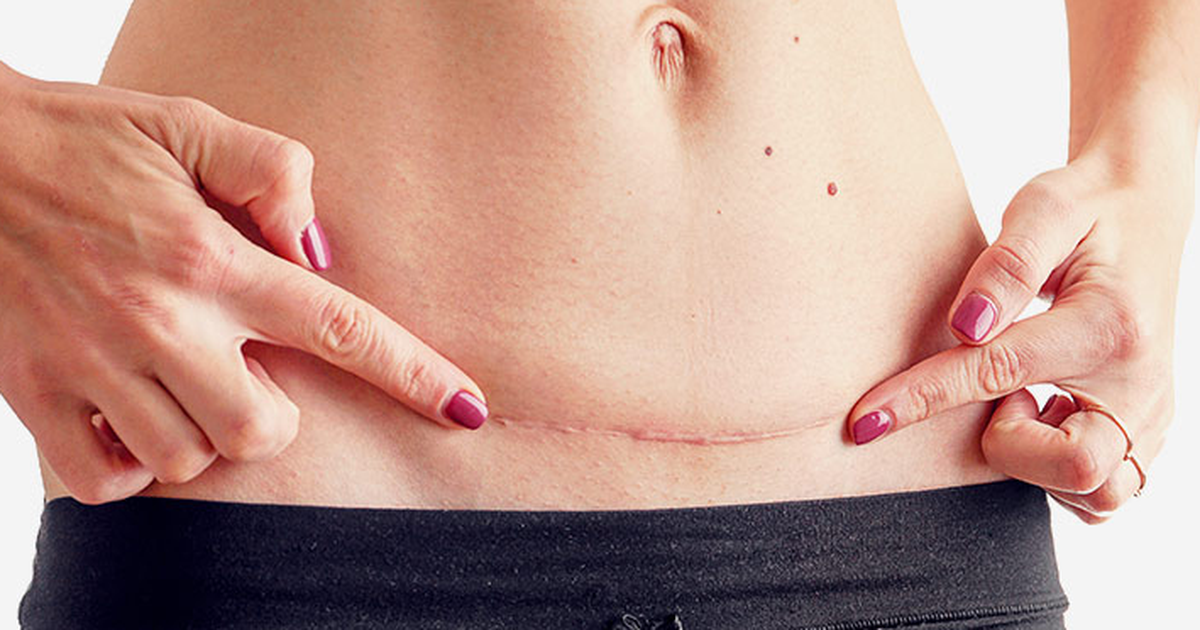 Kem xóa mờ sẹo sau mổ đẻ mà các mẹ cần tham khảo ngay