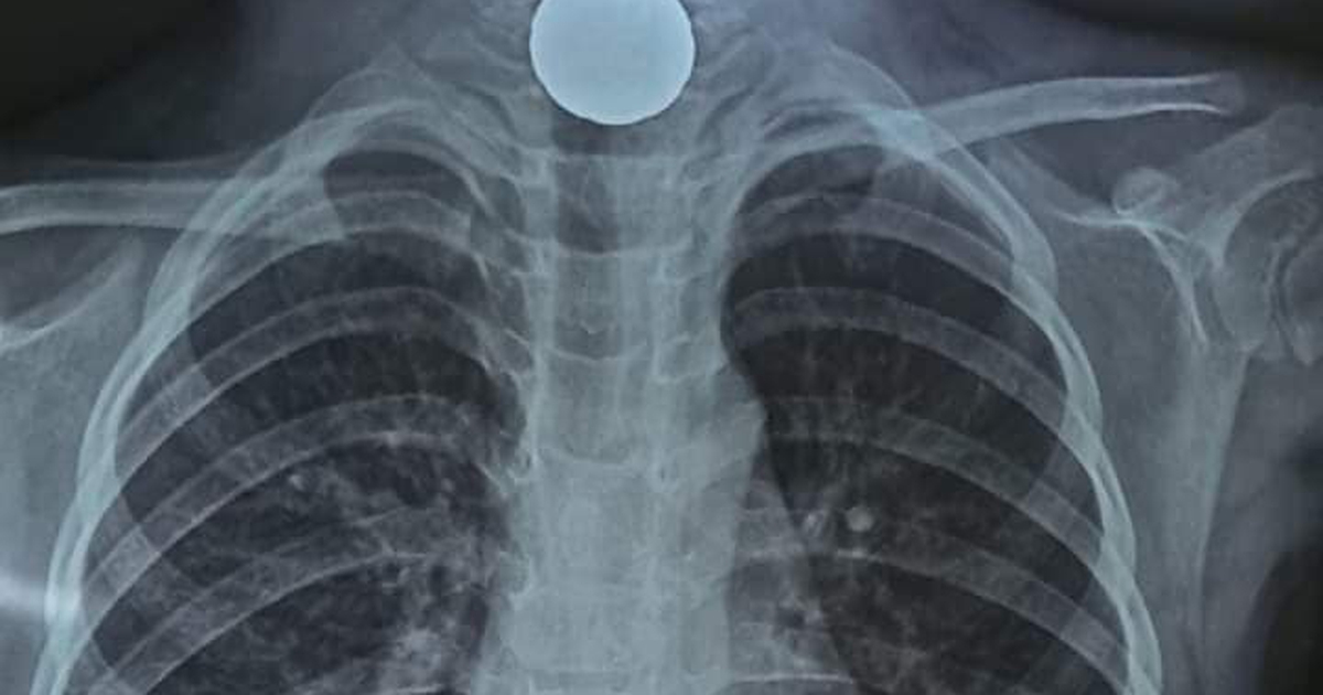 Hà Tĩnh: Bé gái 5 tuổi nuốt đồng xu vào thực quản