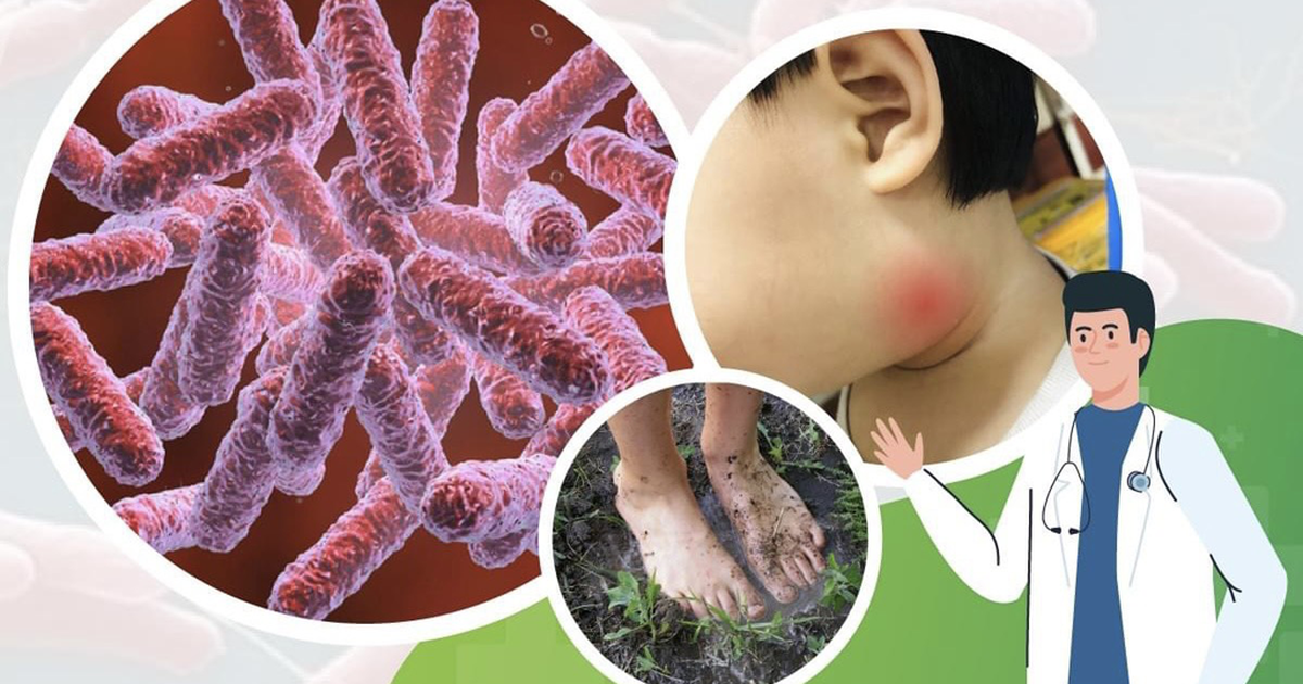 Bệnh Whitmore khó chẩn đoán, dễ gây tử vong do sốc nhiễm trùng