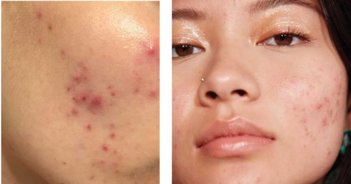 3 hậu quả đáng sợ khi tự nặn mụn không đúng cách