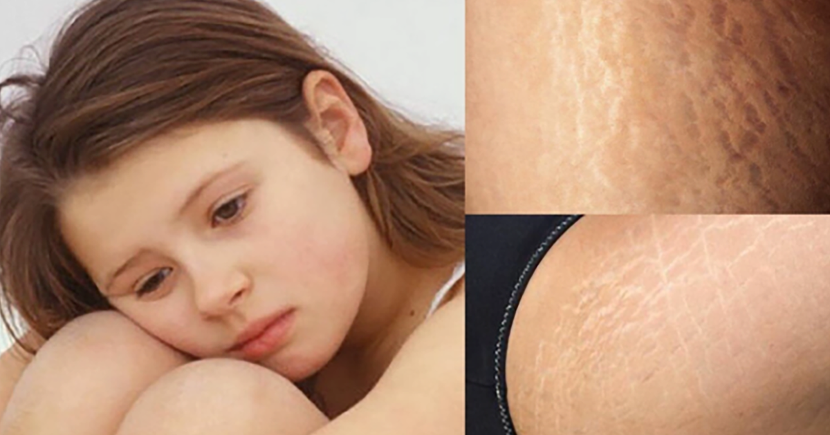 Kem trị rạn da tuổi dậy thì có hiệu quả?