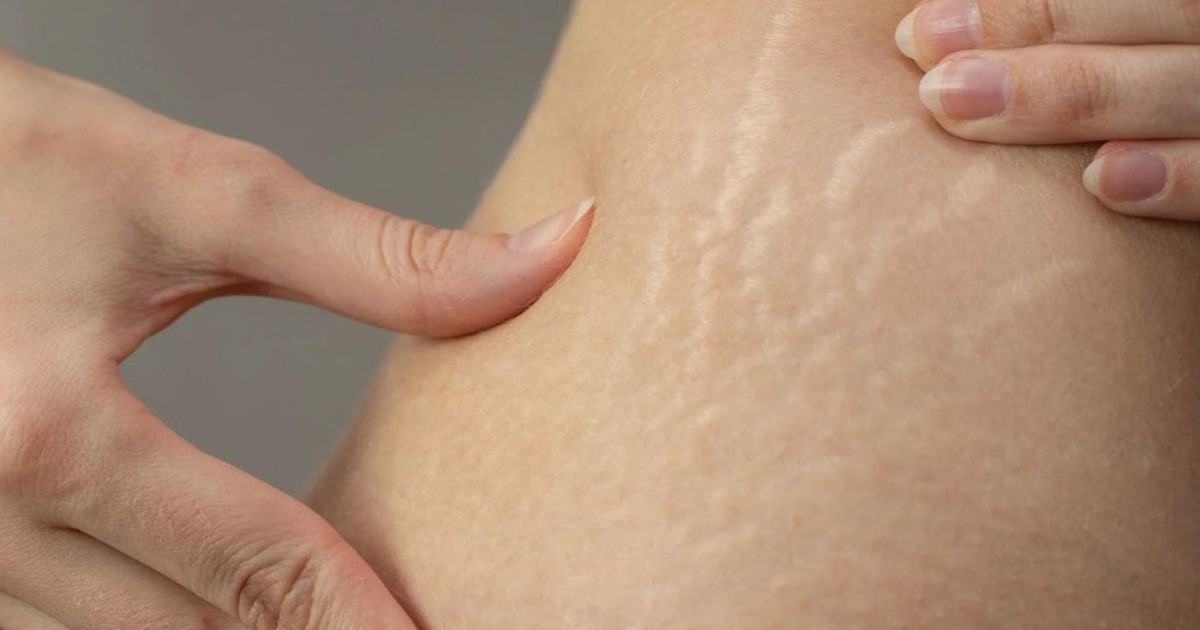 Vết rạn da trắng là gì? Có điều trị hết bằng kem rạn da được không?