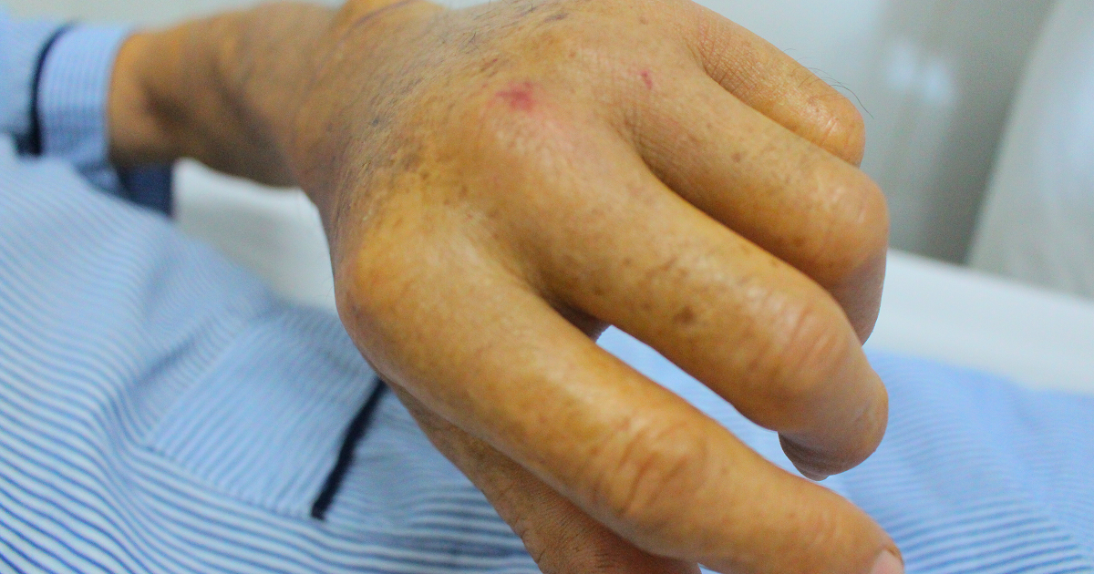 2 người bị rắn lục đuôi đỏ cắn khi đang làm vườn