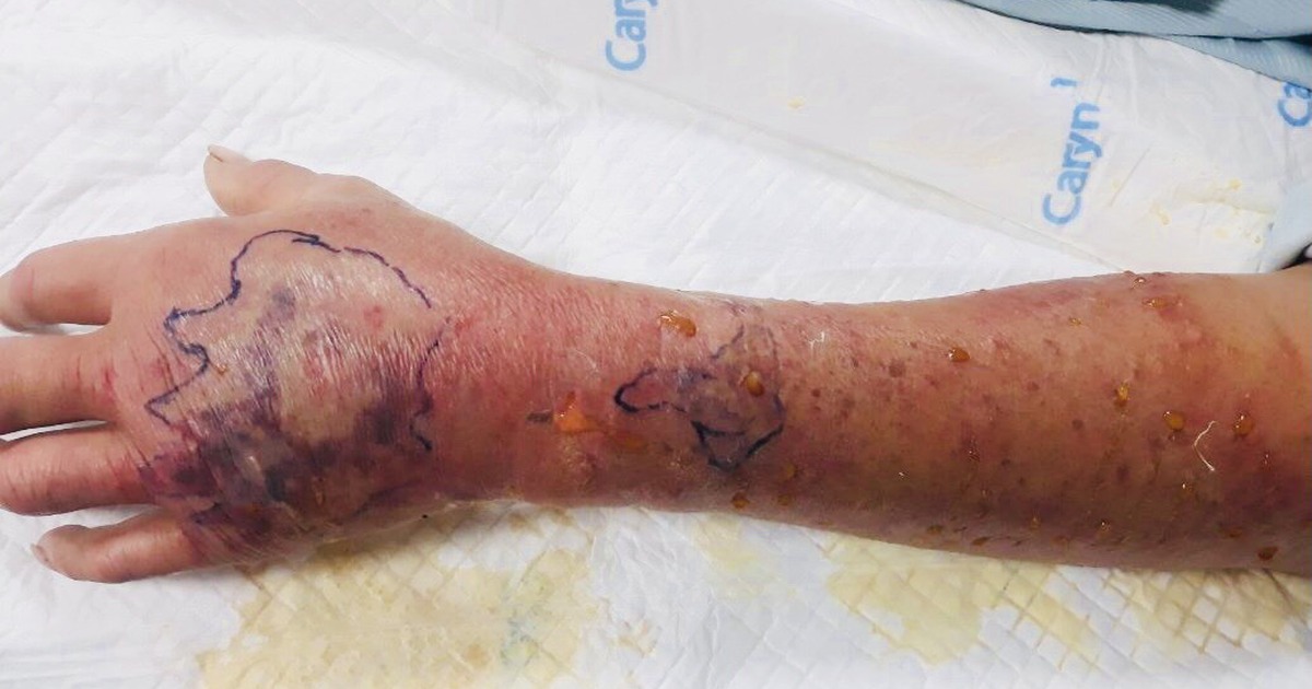 Vết thương do người cắn có thể gây nhiễm trùng máu nguy hiểm