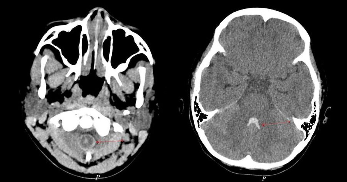 Cứu sống bệnh nhi 10 tuổi bị xuất huyết não