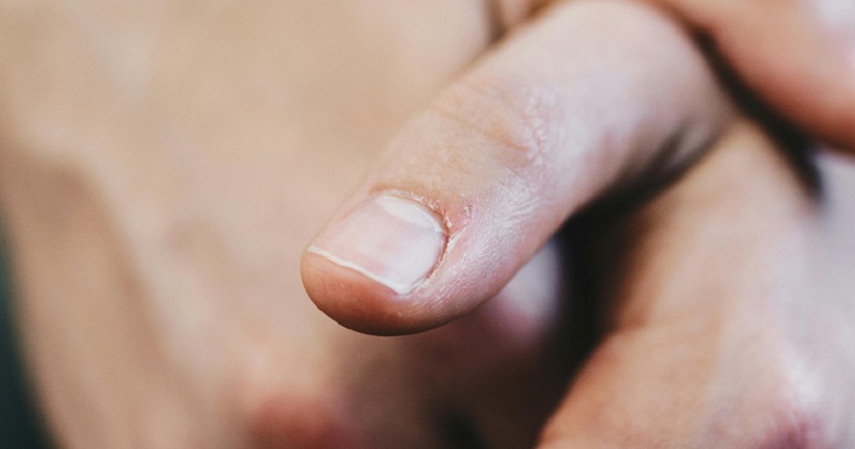 Móng tay đổi màu bất thường, khi nào là dấu hiệu bệnh?