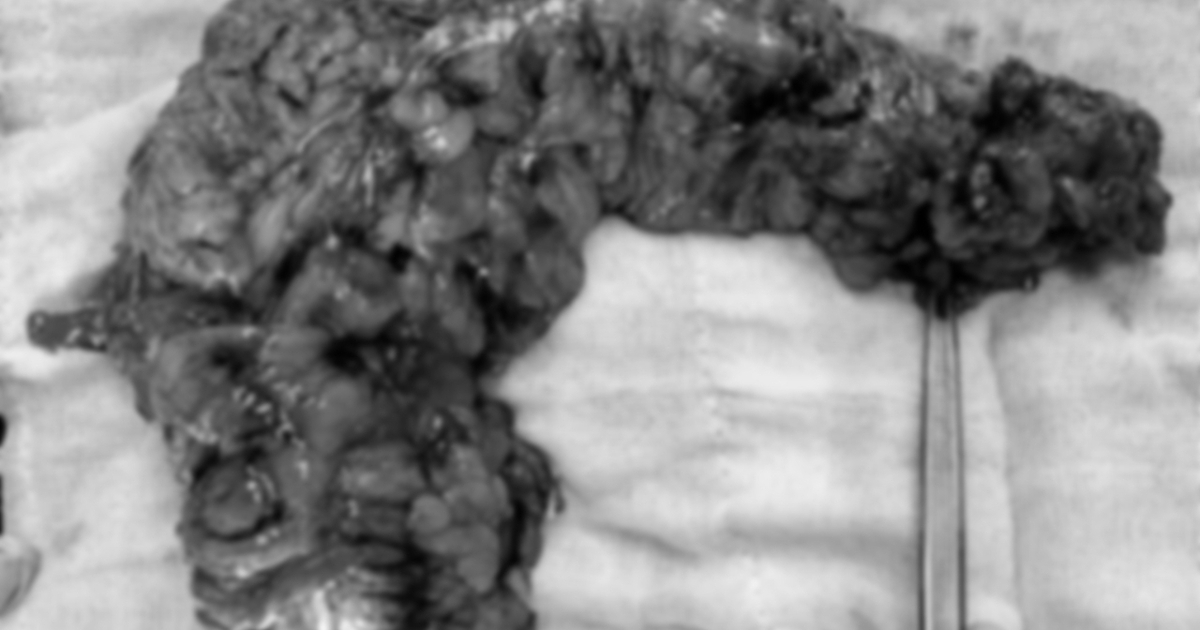 Đau bụng quanh rốn, rối loạn tiêu hóa đi khám phát hiện ung thư đại tràng