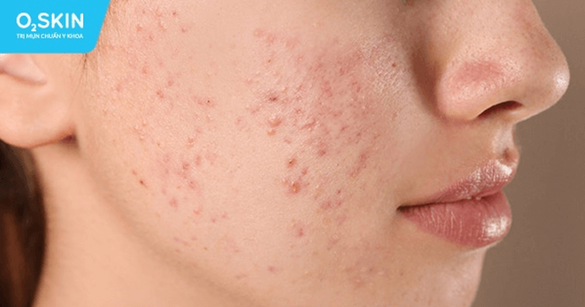 Điều trị mụn trứng cá cần bao lâu để thấy được hiệu quả?