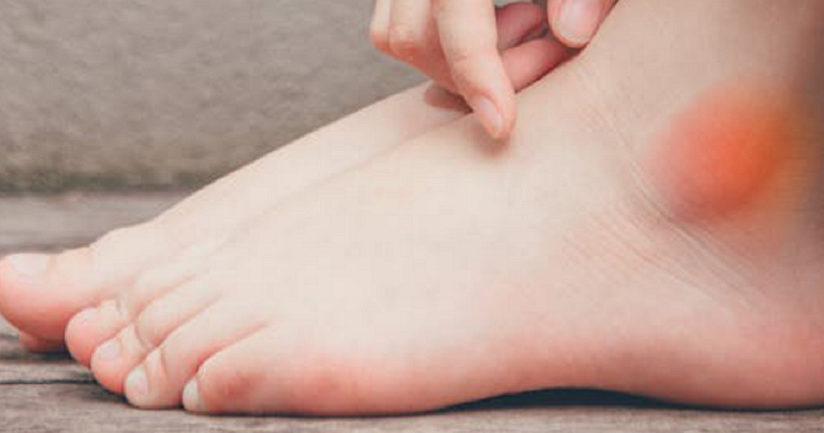 Sưng ph&ugrave; mắt c&aacute; ch&acirc;n: 4 căn bệnh nguy hiểm c&oacute; thể đang mắc