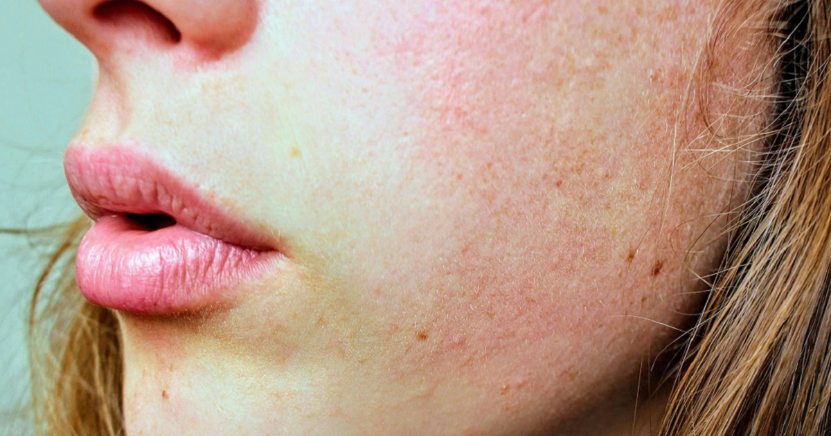 3 dấu hiệu xuất hiện trên mặt cảnh báo ung thư dạ dày