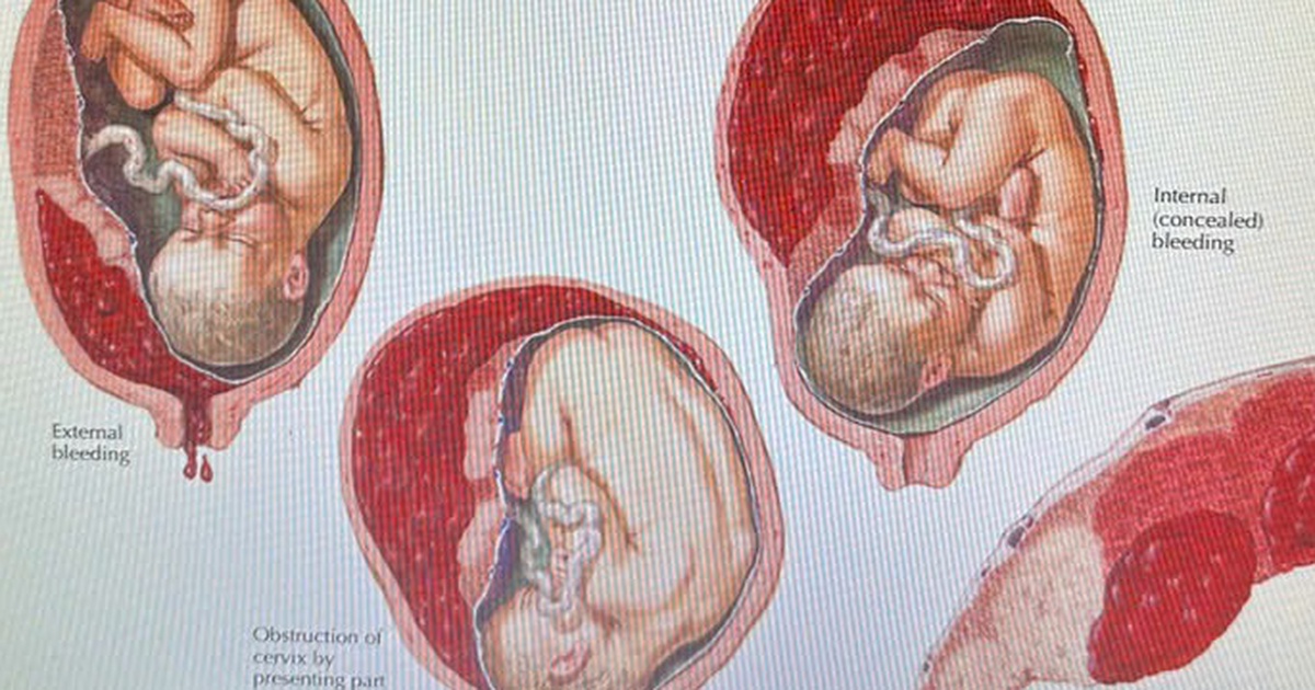 Cứu sống thai phụ bị nhau bong non thể nặng