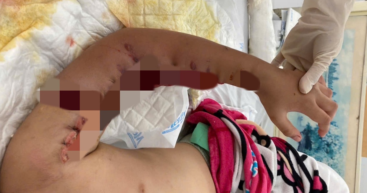 Kẹt tay vào máy giặt, bé gái 8 tuổi bị đứt lìa tay trái