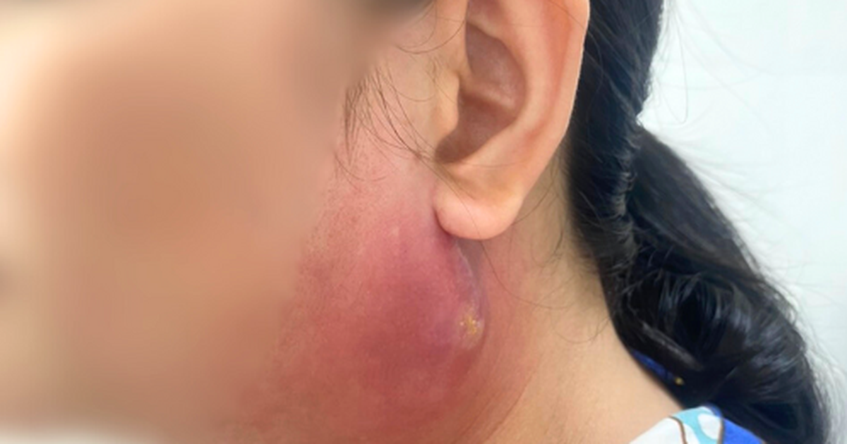 Từ mụn nhọt bằng hạt đậu thành ổ áp xe lớn trên mặt người phụ nữ