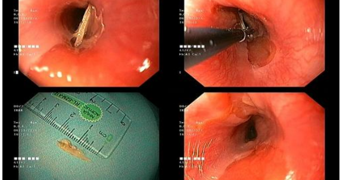 Hàng trăm trẻ em bị dị vật đường tiêu hóa mỗi năm, rất nguy hiểm