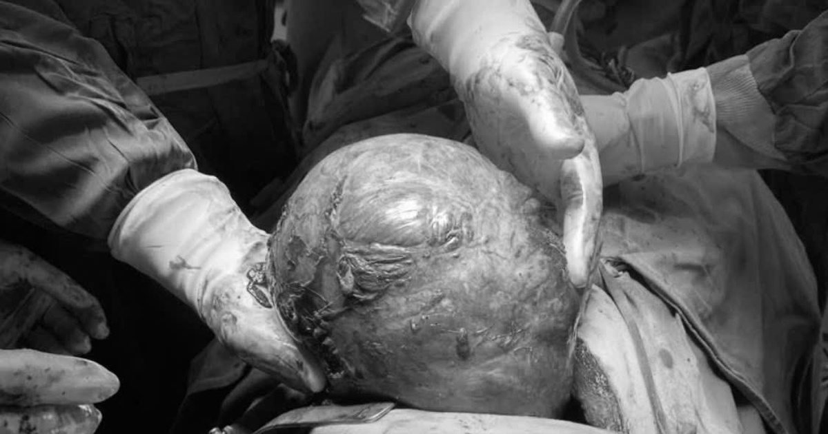 Nữ bệnh nhân bị khối u 2 kg chèn xẹp phổi