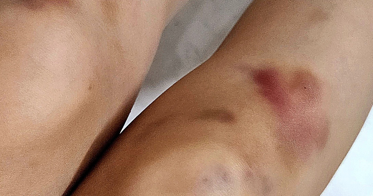 Những dấu hiệu n&agrave;o của vết bầm cần phải đi kh&aacute;m?