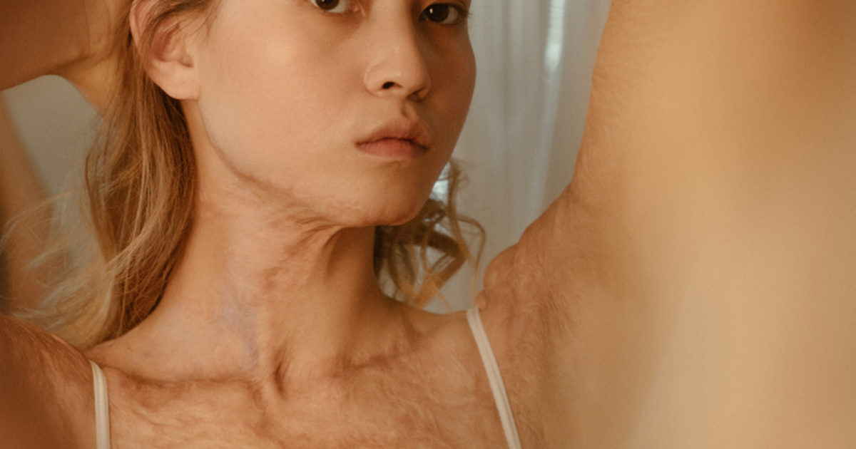 Sẹo không chỉ ảnh hưởng thẩm mỹ mà còn sức khỏe tinh thần