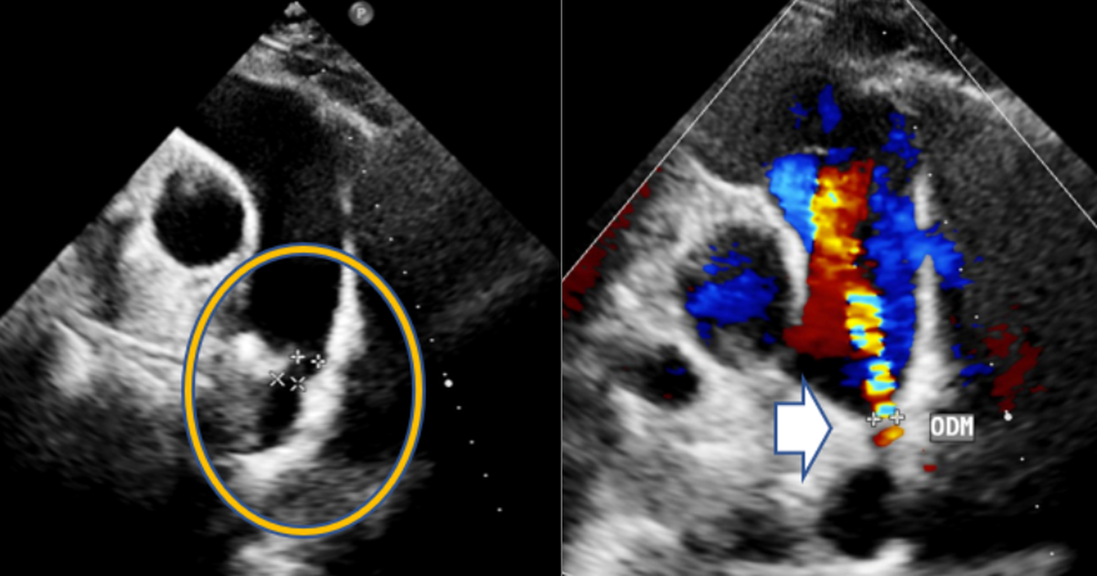 Bàng hoàng phát hiện dị tật tim bẩm sinh sau hơn 30 năm sống khỏe mạnh