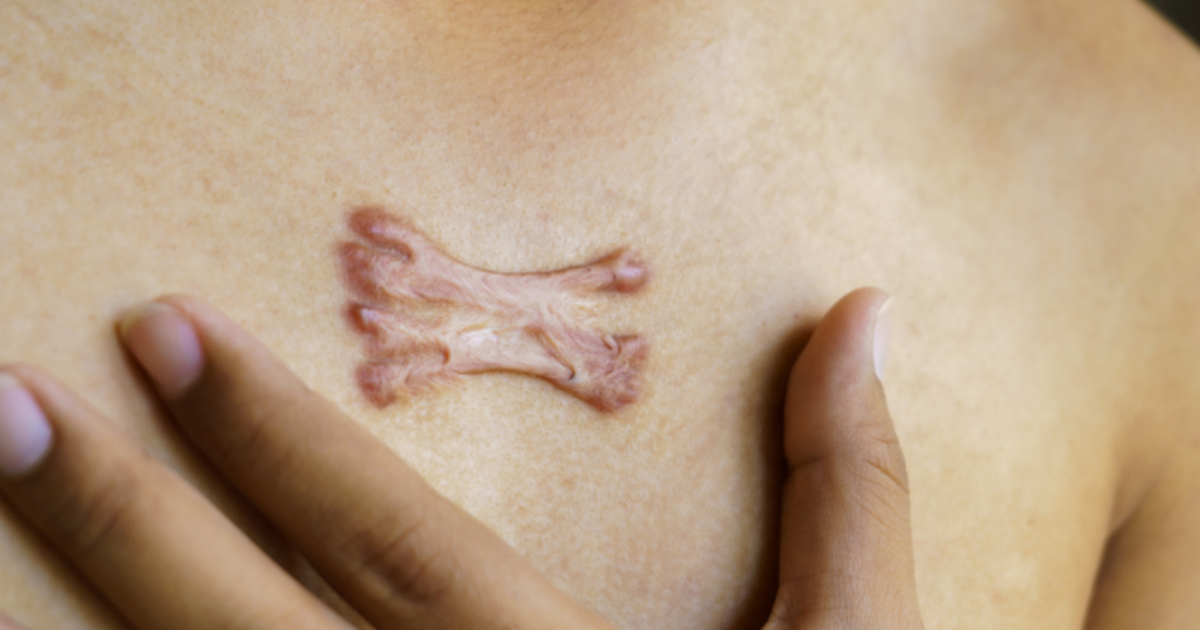 [Review nhanh] Top 5 cách trị sẹo lồi đang được thực hiện nhiều hiện nay