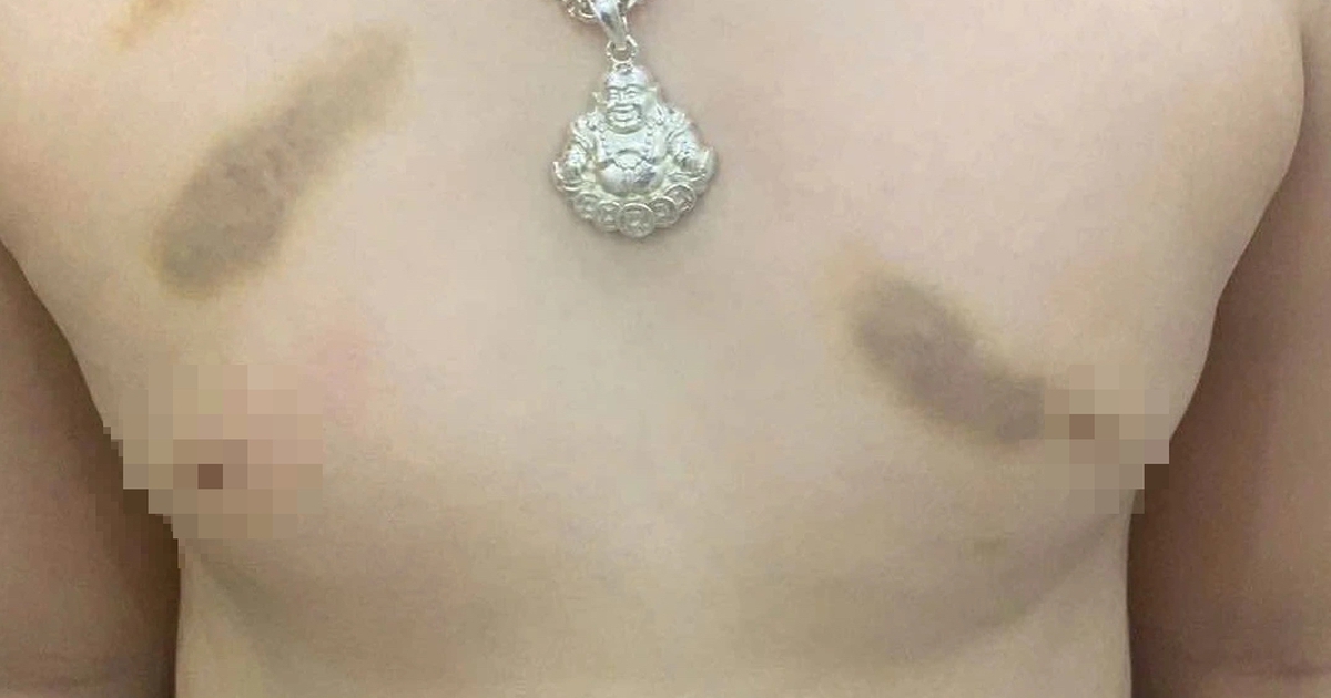 Phụ huynh tố gi&aacute;o vi&ecirc;n bạo h&agrave;nh trẻ, y&ecirc;u cầu bồi thường 1 năm học ph&iacute;