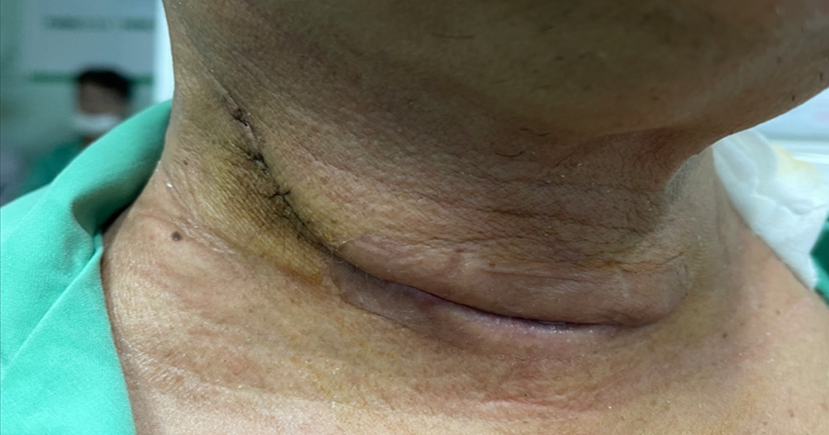 Khàn tiếng kéo dài, đi khám phát hiện mắc cùng lúc 2 loại ung thư