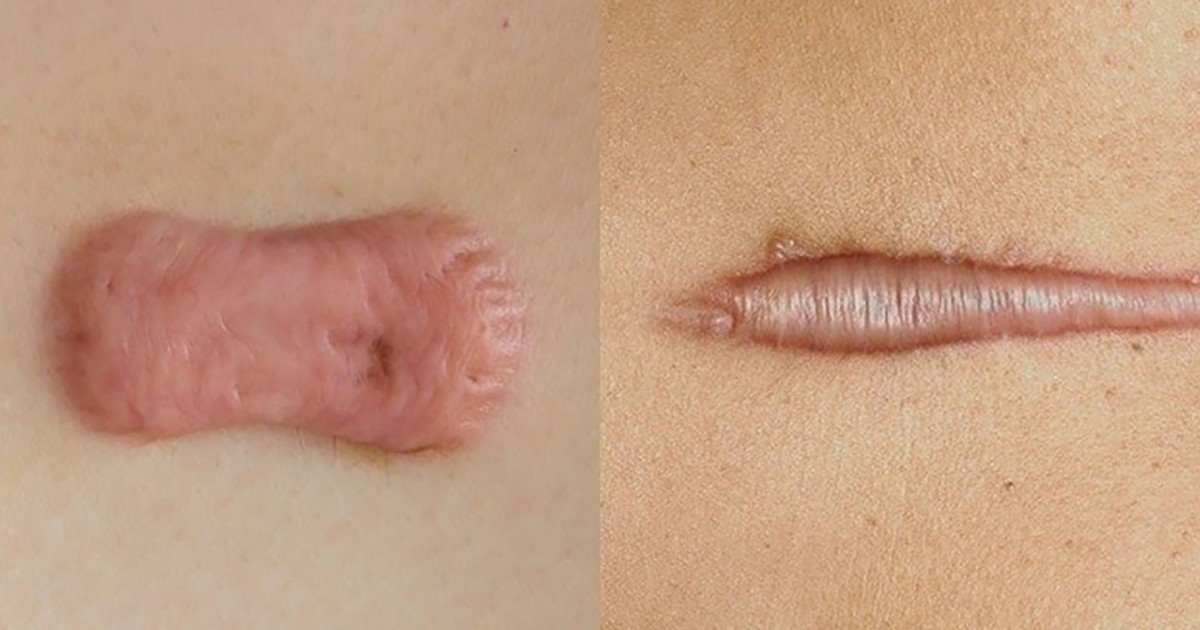 Scar FX & Rejuvasil khác gì so với các giải pháp chăm sóc sẹo thông thường?