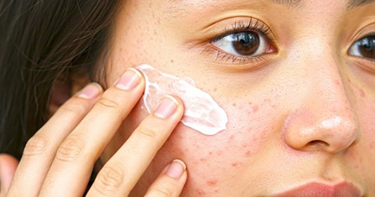 Tạm biệt sẹo rỗ, 5 bí kíp chăm sóc da phục hồi da sau mụn hiệu quả