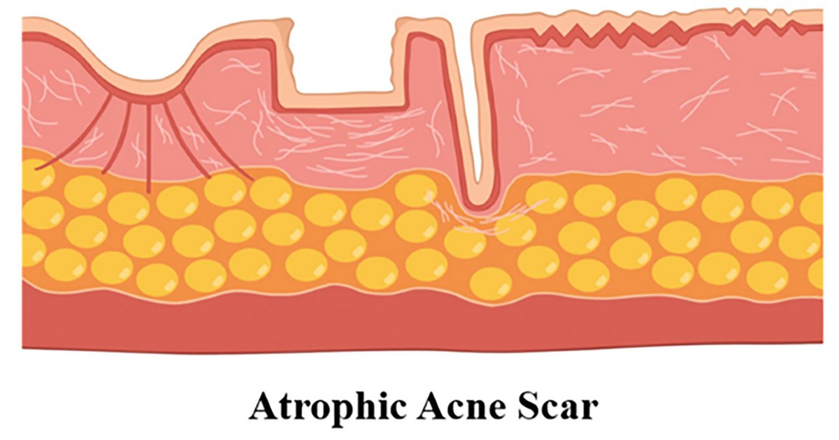 Sẹo mụn hình thành như thế nào? Hiểu nguyên nhân nắm rõ cách xóa sẹo hiệu quả