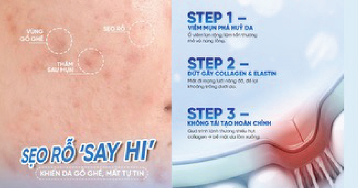 Đừng để sẹo mụn kéo lùi bạn, chăm da đẹp, tự tin trở lại, cơ hội đến