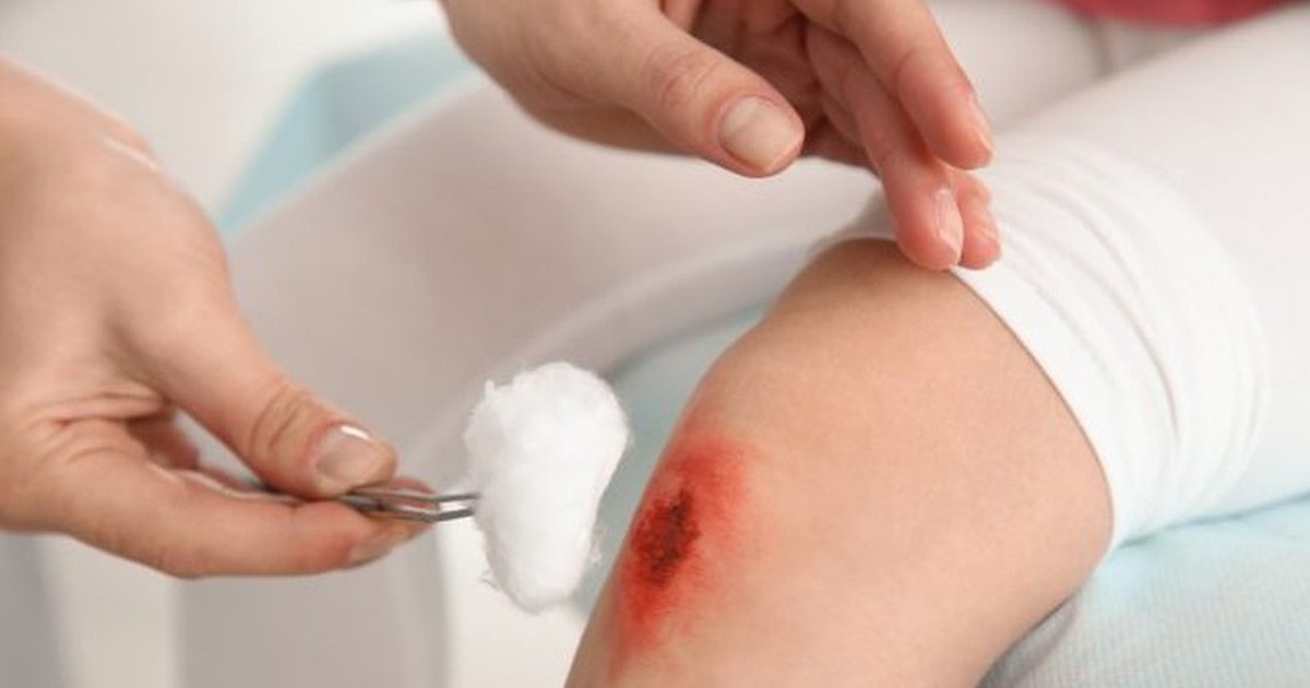 Phòng ngừa nhiễm trùng từ vết thương hở: Bật mí từ chuyên gia da liễu