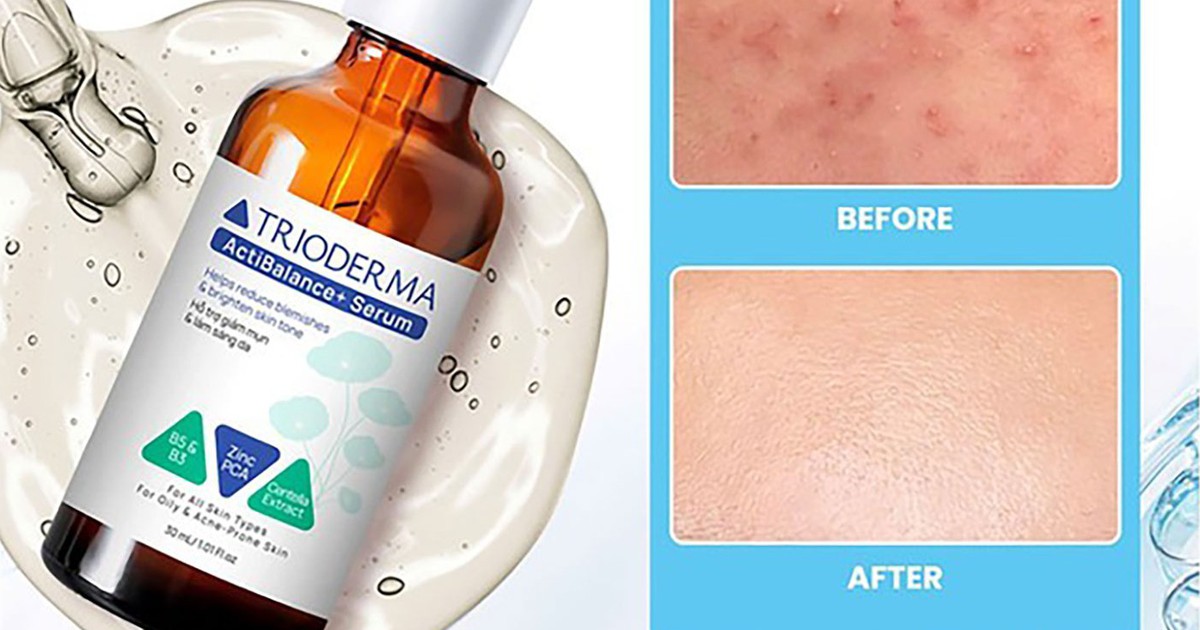 Hướng dẫn sử dụng serum giúp ngừa mụn Trioderma đúng chuẩn chuyên gia cho da khỏe đẹp