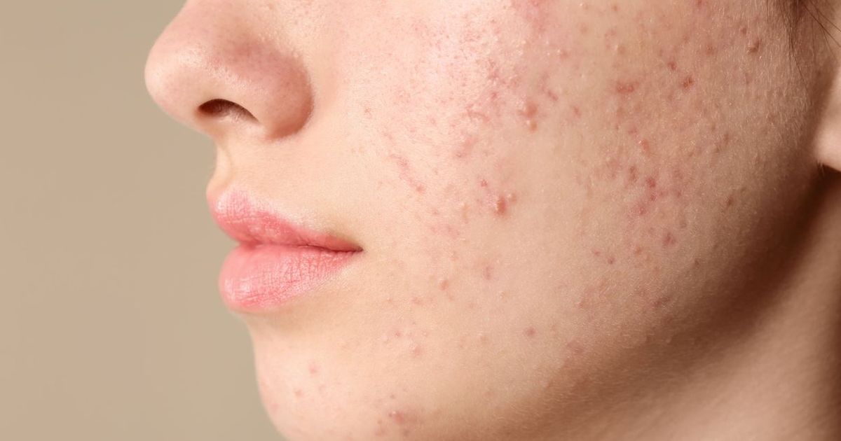 Vì sao Scar Esthetique là sản phẩm dành cho thâm đỏ sau mụn?