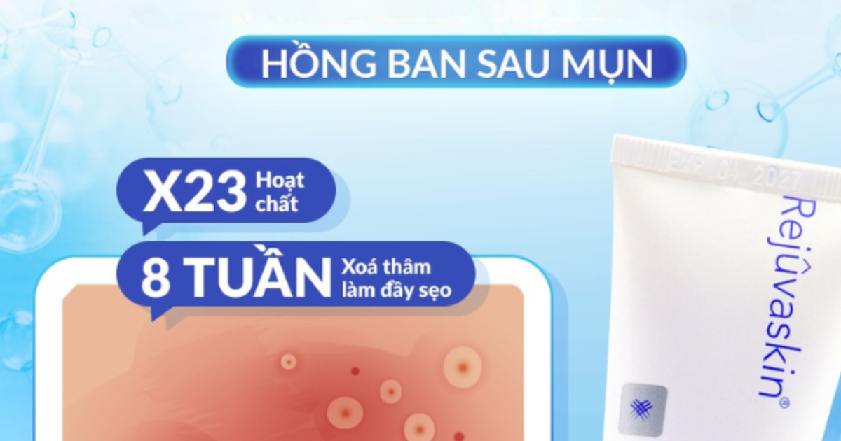 Da hết mụn mà vẫn loang lổ đỏ hồng? 90% chị em đang bỏ qua bước này!