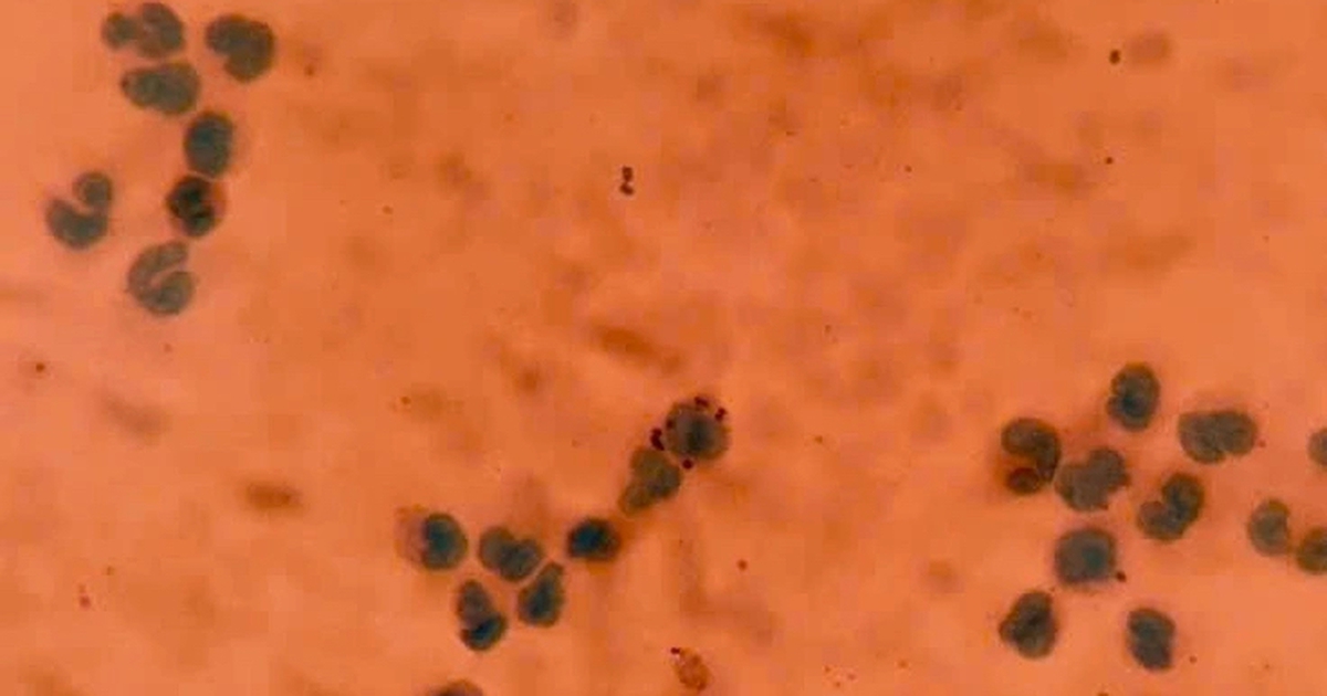 Viêm màng não do não mô cầu: Cả nước 84 ca mắc, 1 ca tử vong