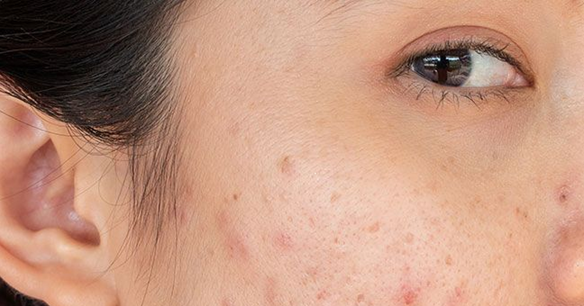 Cải thiện thâm mụn trong 4 tuần với một bước chăm da cuối cùng