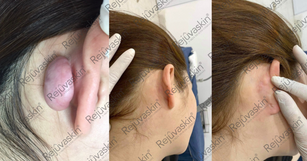 Nâng cấp hiệu quả điều trị sẹo lồi với lời khuyên từ chuyên gia da liễu