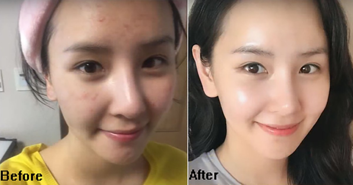 Top 10 kem chống nắng cho da mụn: Ai dùng rồi cũng nguyện chung thủy tới già