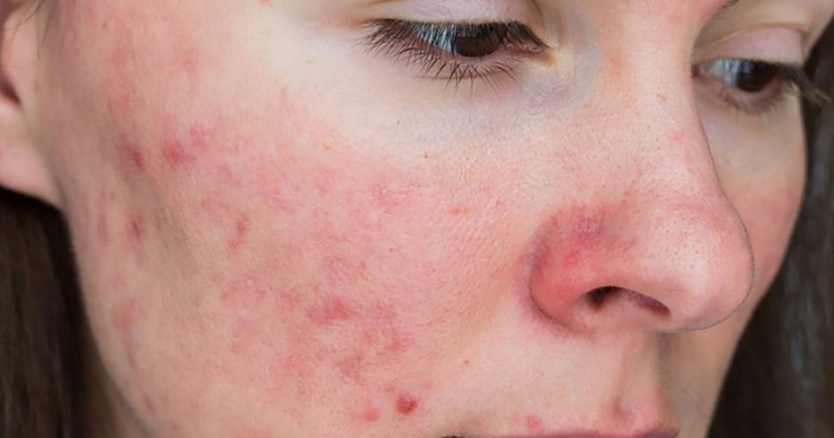 Vì đâu tổn thương da do mụn kéo dài mãi không hết?