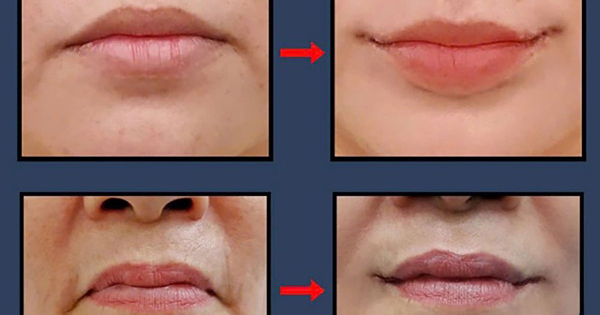 Smile Lipt bí quyết tạo khóe môi cười tự nhiên của bác sĩ Bảo Tiên