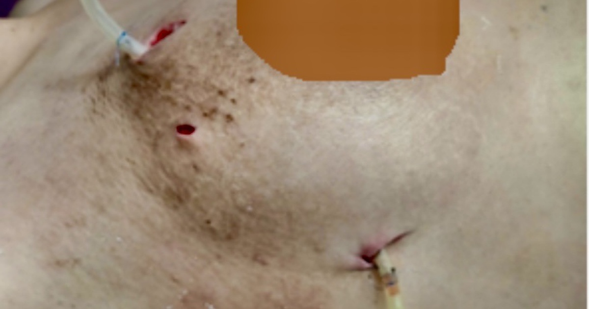 Ngực biến dạng do tiêm filler làm đẹp