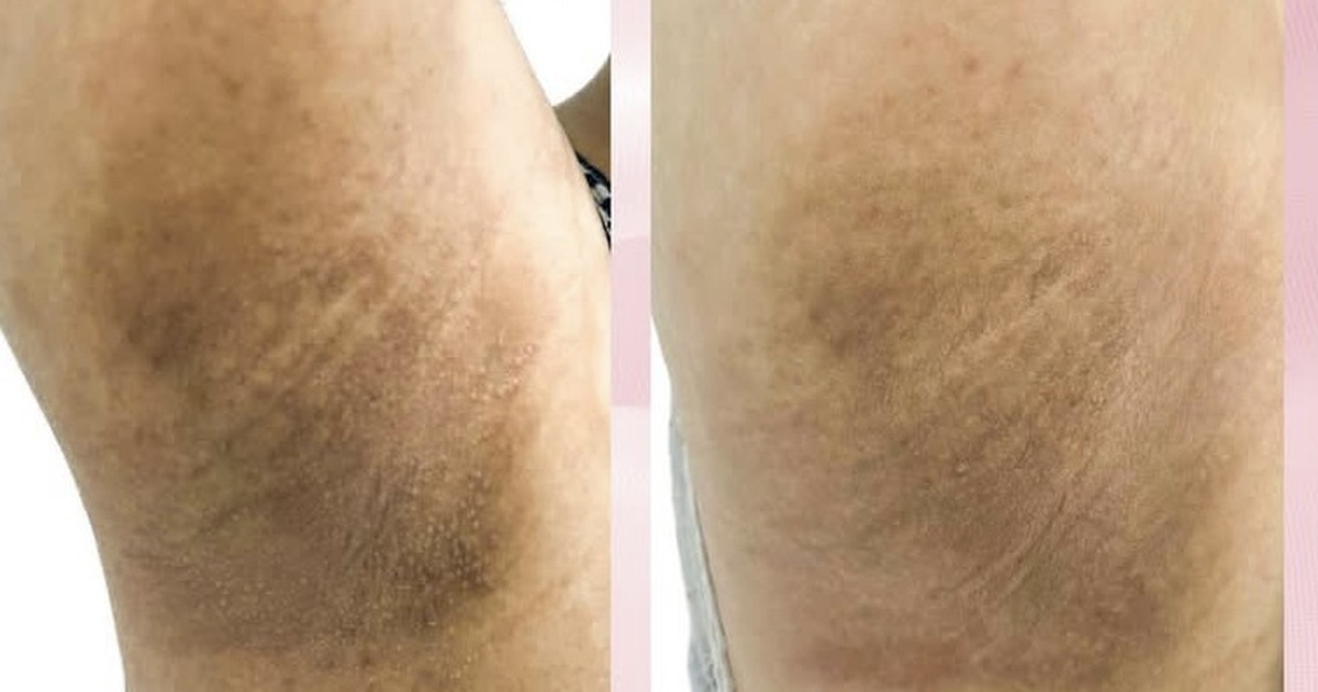 Bệnh nhân nữ khổ sở vì đổ nhiều mồ hôi